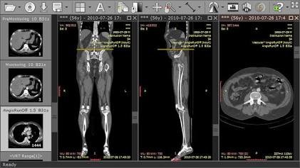 Reconstrucción multiplanar y volumen 3D en un visor DICOM de código abierto
