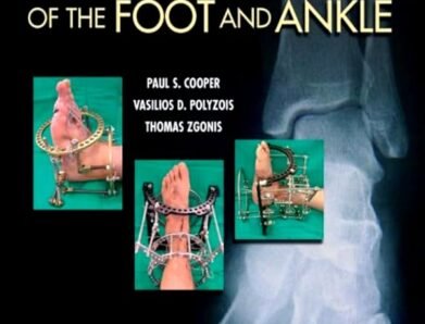 External Fixators of the Foot and Ankle